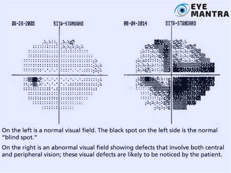 Visual Field Test .